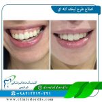 اصلاح-لبخند-لثه-ای