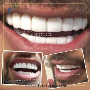 اصلاح طرح لبخند دو فک