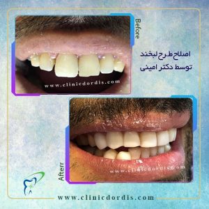 عکس اصلاح طرح لبخند