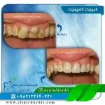 لمینت دندان طبیعی