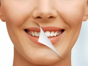 بلیچینگ دندان در سعادت آباد کلینیک دردیس