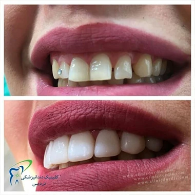 لمینت دندان