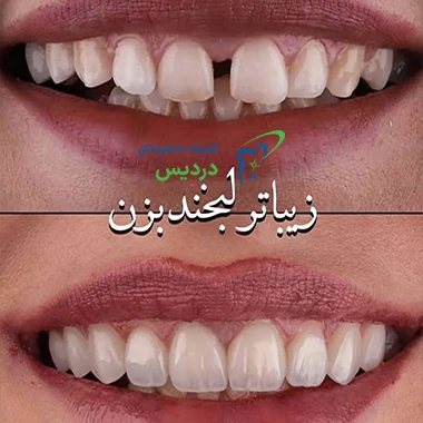 نمونه کار لمینت دندان