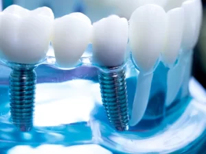 ایمپلنت در غرب تهران دردیس