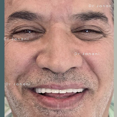 ایمپلنت دندان در غرب تهران کلینیک دردیس