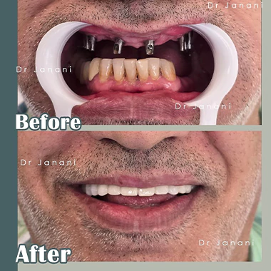 ایمپلنت دندان غرب تهران