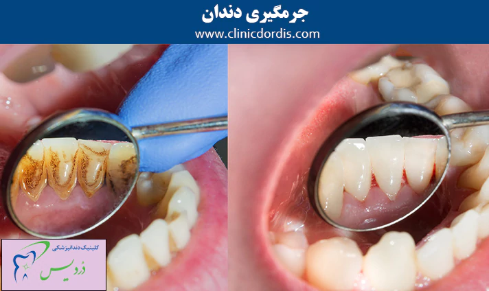 جرمگیری دندان