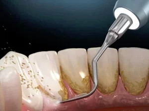 مزایای جرمگیری دندان