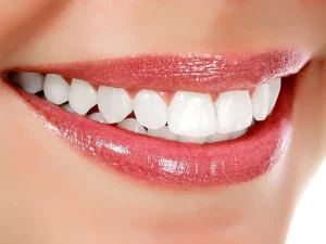 اهمیت رعایت مراقبت های بعد جرمگیری دندان