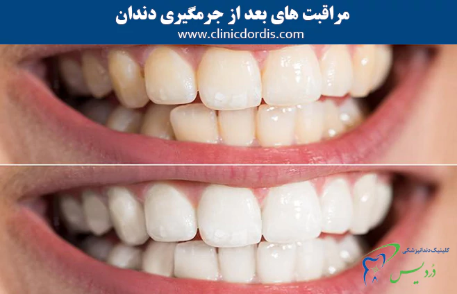 مراقبت های بعد از جرمگیری دندان