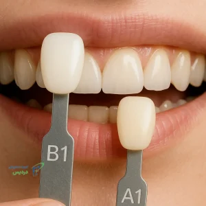 تفاوت رنگ دندان a1 و b1