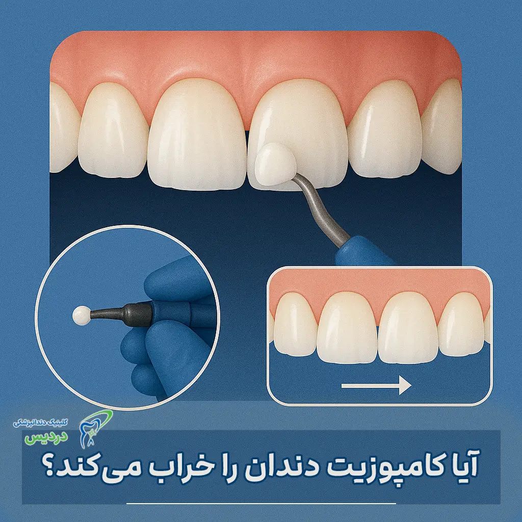 عوارض کامپوزیت دندان