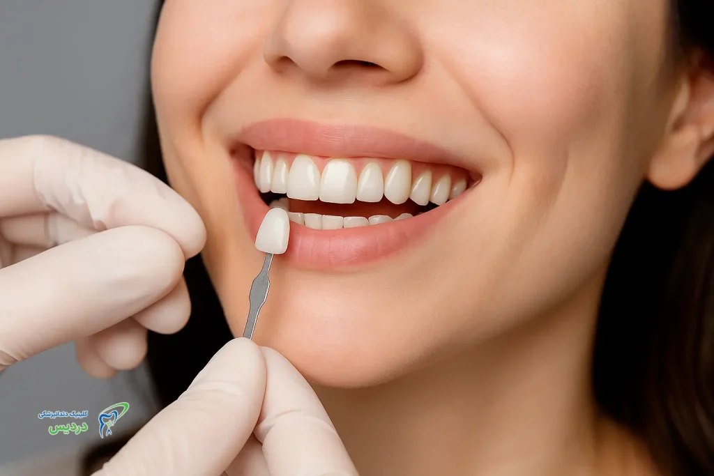 مراقبت‌های ضروری بعد از کامپوزیت