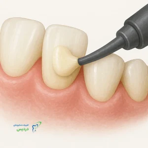 آیا کامپوزیت دندان را خراب می کند
