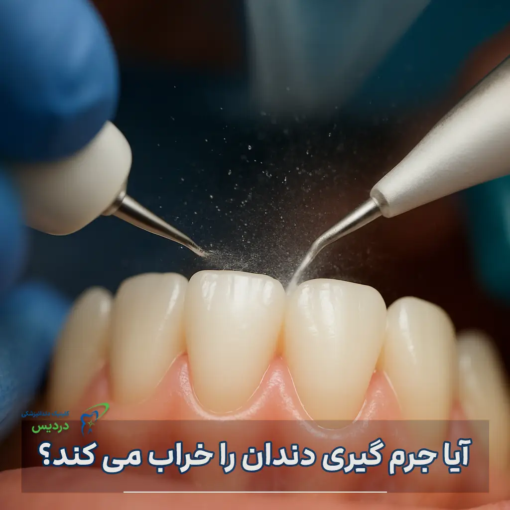آیا جرم گیری دندان را خراب می کند؟