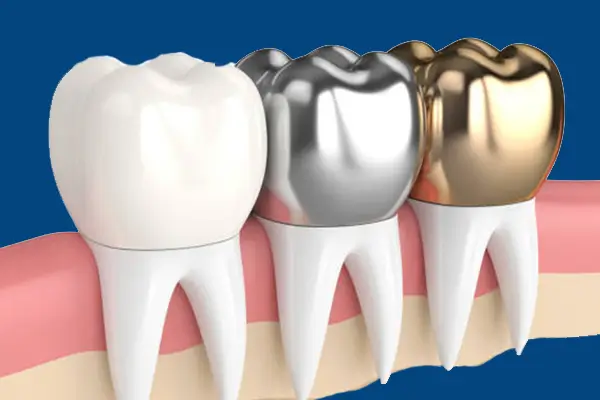 مراحل روکش دندان