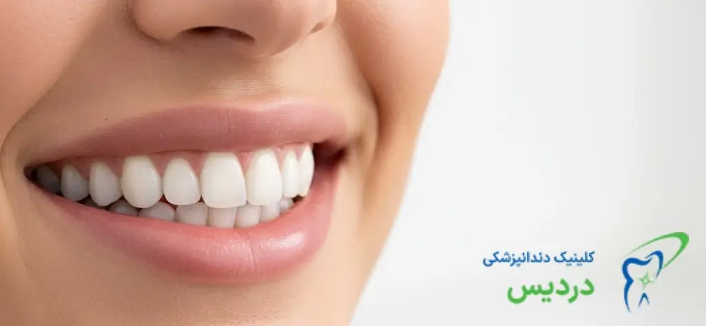 هزینه لمینت دندان