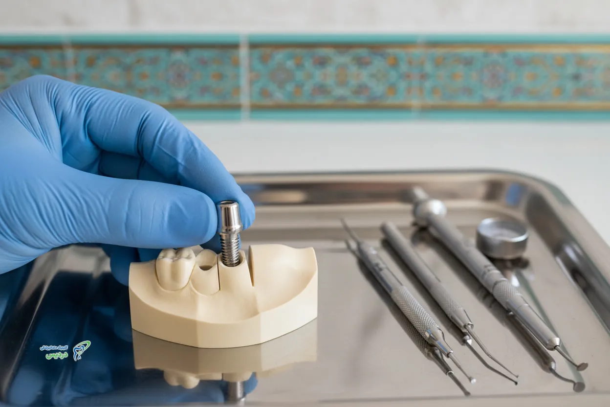 مقایسه ایمپلنت تک دندان با بریج و پروتز برای جای خالی یک دندان