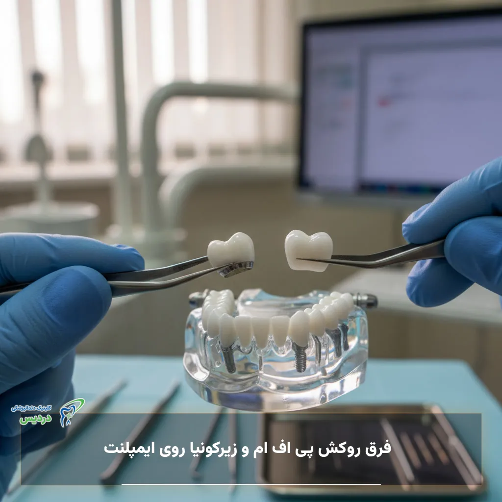 فرق روکش پی اف ام و زیرکونیا روی ایمپلنت از نظر زیبایی و استحکام