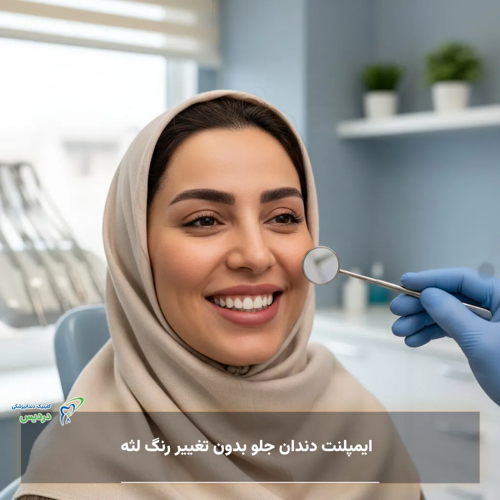 ایمپلنت دندان جلو بدون تغییر رنگ لثه
