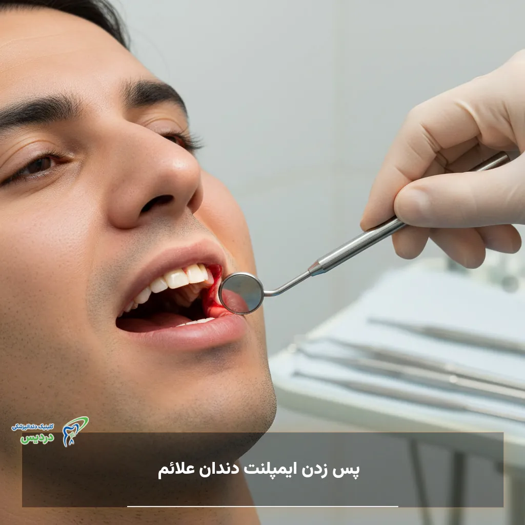 علائم پس زدن ایمپلنت دندان مانند درد، تورم لثه و لق شدن