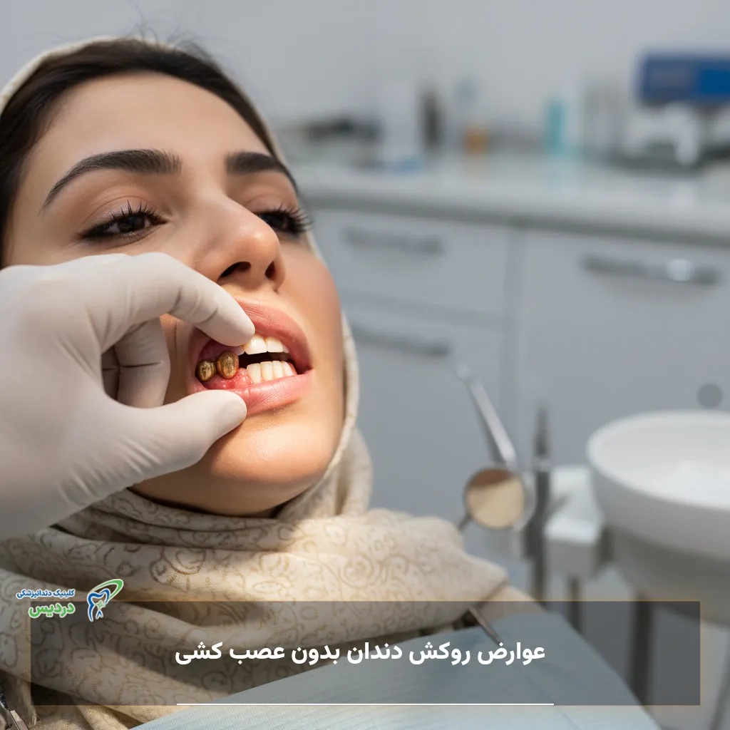 عوارض روکش دندان بدون عصب کشی و مشکلات احتمالی دندان زنده زیر روکش
