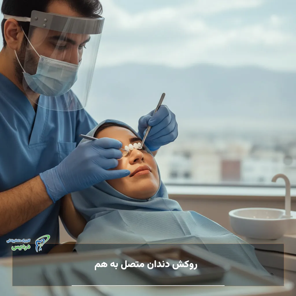 روکش دندان متصل به هم (بریج/روکش یکسره)