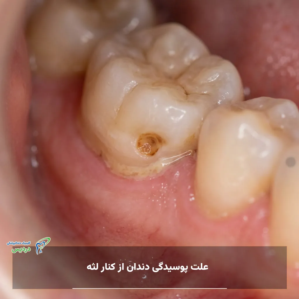 پوسیدگی دندان در ناحیه خط لثه