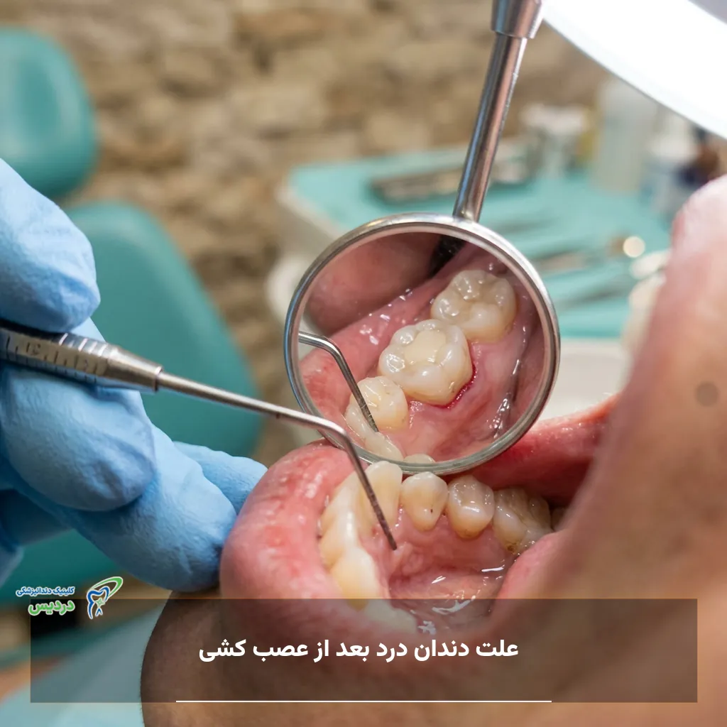 درد دندان پس از عصب‌کشی و التهاب اطراف ریشه