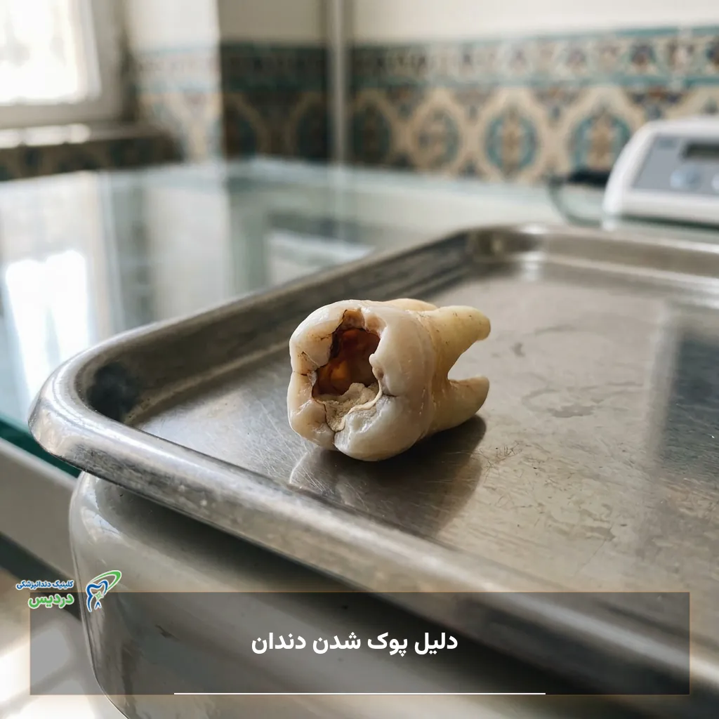 مراحل ایجاد پوسیدگی و پوک شدن دندان