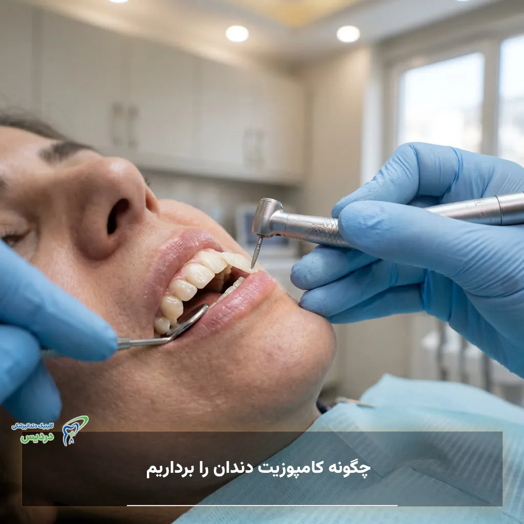 بررسی و تعویض کامپوزیت دندان