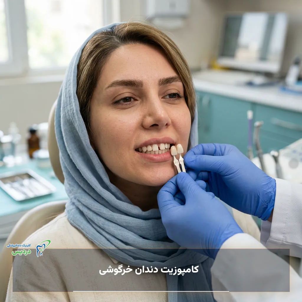 نمونه فرم دندان خرگوشی با کامپوزیت