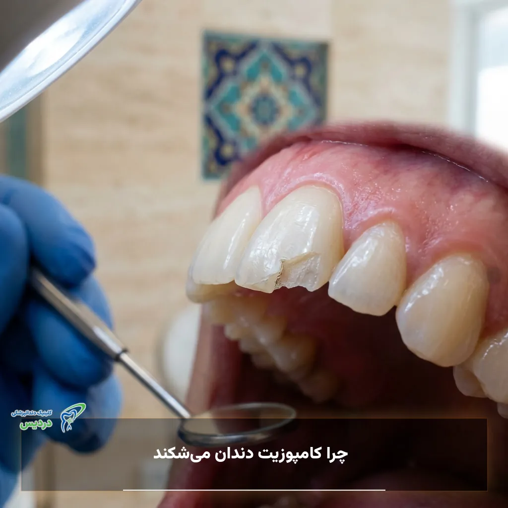 علت‌های شکستن و لب‌پر شدن کامپوزیت دندان